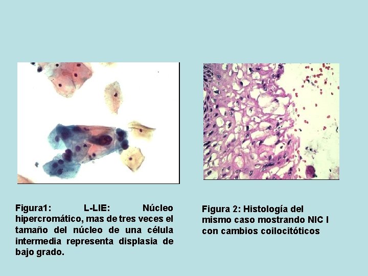 Figura 1: L-LIE: Núcleo hipercromático, mas de tres veces el tamaño del núcleo de