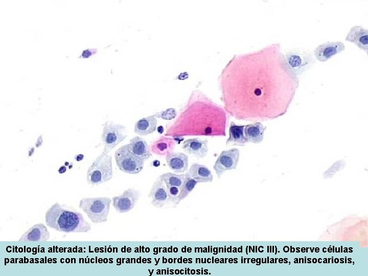 Citología alterada: Lesión de alto grado de malignidad (NIC III). Observe células parabasales con