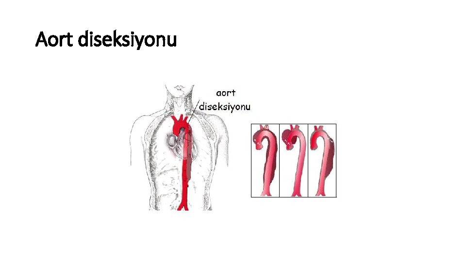 Aort diseksiyonu Aort diseksiyonu