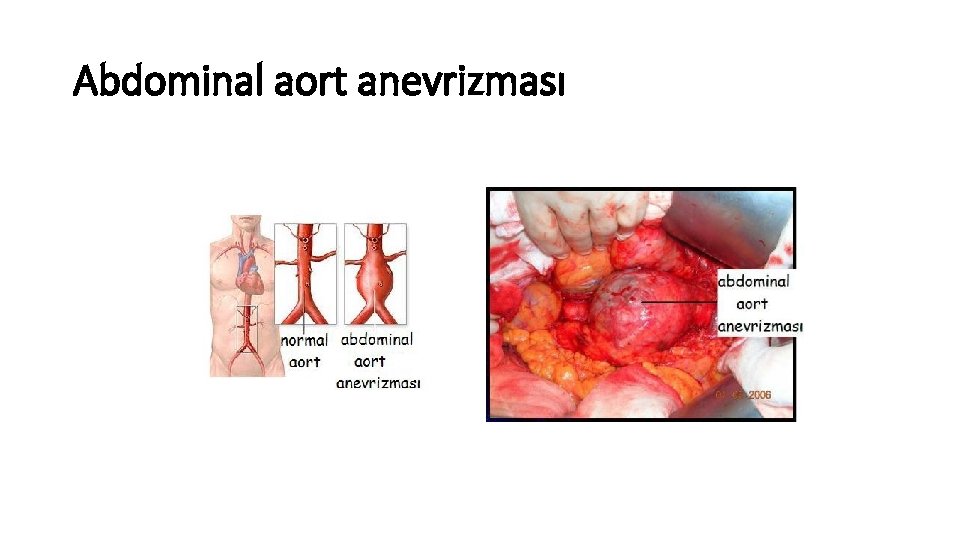 Abdominal aort anevrizması Abdominal aort anevrizması