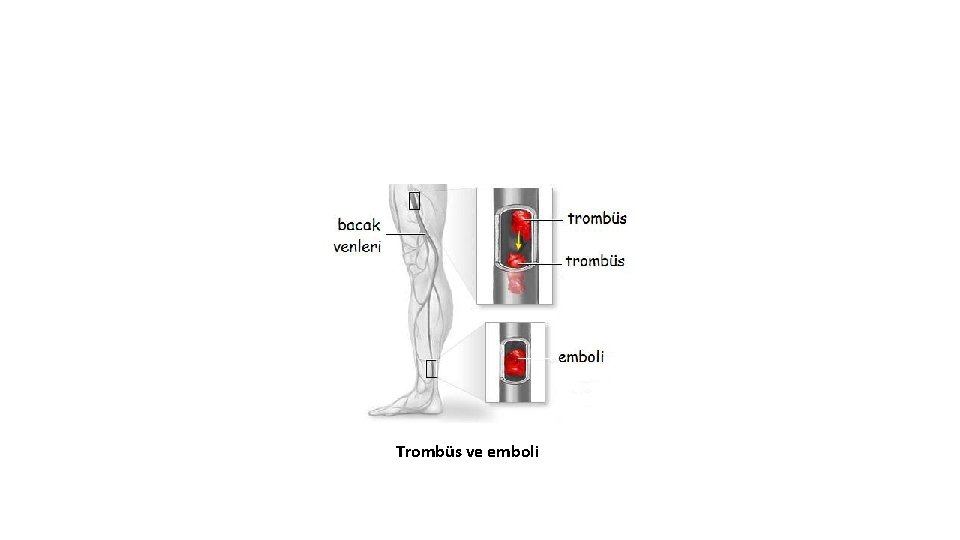 Trombüs ve emboli Trombüs ve emboli