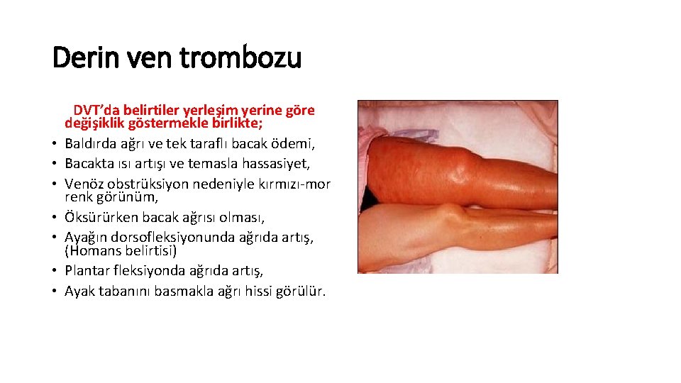 Derin ven trombozu • • DVT’da belirtiler yerleşim yerine göre değişiklik göstermekle birlikte; Baldırda Derin ven trombozu • • DVT’da belirtiler yerleşim yerine göre değişiklik göstermekle birlikte; Baldırda