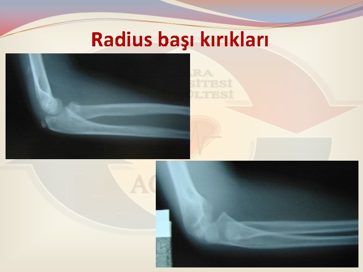 Radius başı kırıkları 