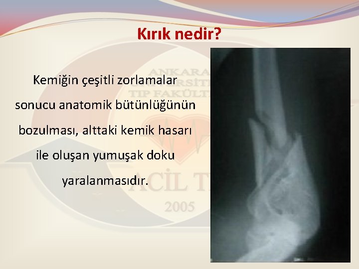 Kırık nedir? Kemiğin çeşitli zorlamalar sonucu anatomik bütünlüğünün bozulması, alttaki kemik hasarı ile oluşan