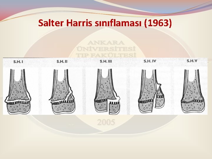 Salter Harris sınıflaması (1963) 