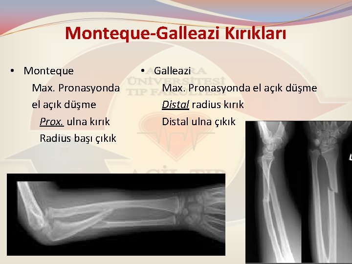 Monteque-Galleazi Kırıkları • Monteque Max. Pronasyonda el açık düşme Prox. ulna kırık Radius başı