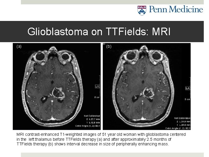 Glioblastoma on TTFields: MRI (a) (b) MRI contrast-enhanced T 1 -weighted images of 51