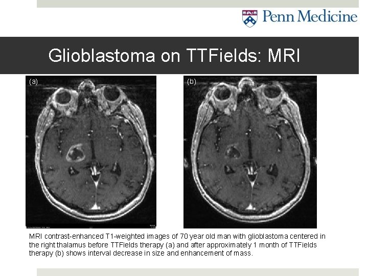 Glioblastoma on TTFields: MRI (a) (b) MRI contrast-enhanced T 1 -weighted images of 70