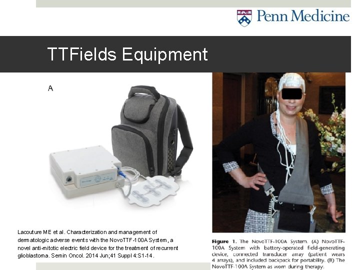 TTFields Equipment Lacouture ME et al. Characterization and management of dermatologic adverse events with