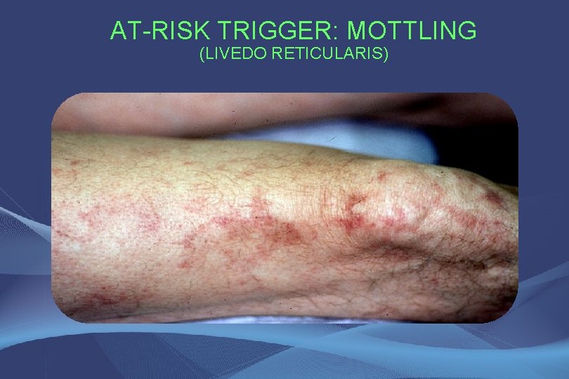 AT-RISK TRIGGER: MOTTLING (LIVEDO RETICULARIS) 