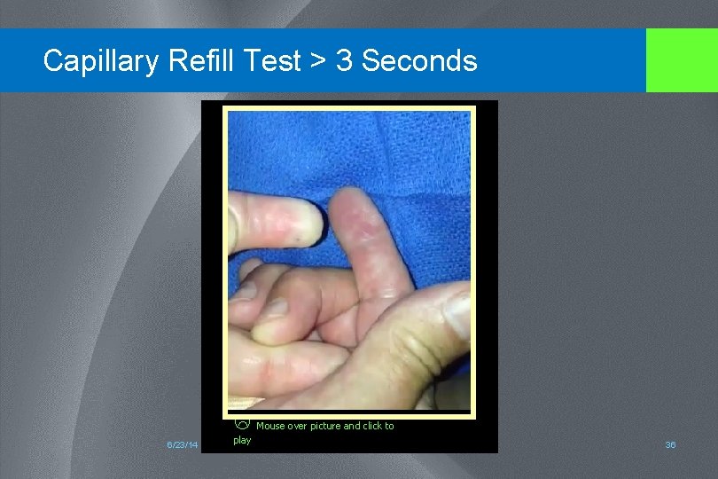 Capillary Refill Test > 3 Seconds 6/23/14 play Mouse over picture and click to