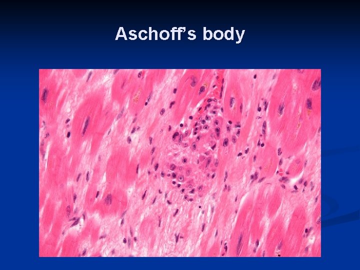 Aschoff’s body 