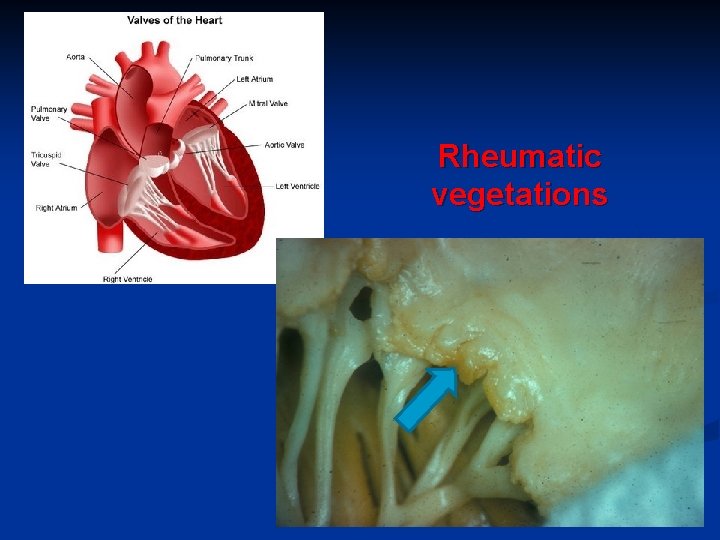 Rheumatic vegetations 