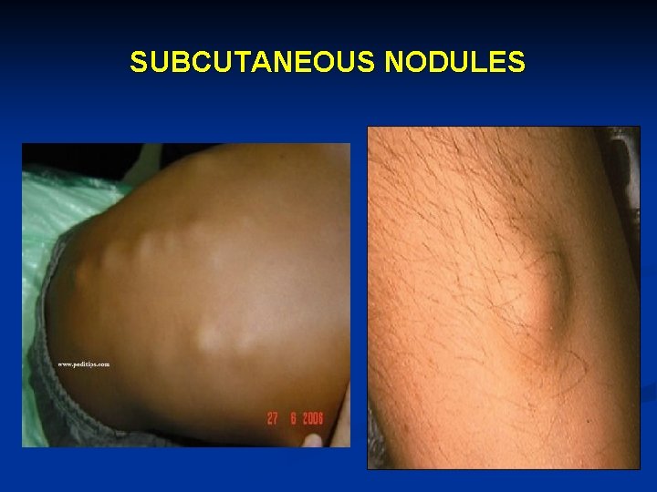 SUBCUTANEOUS NODULES 