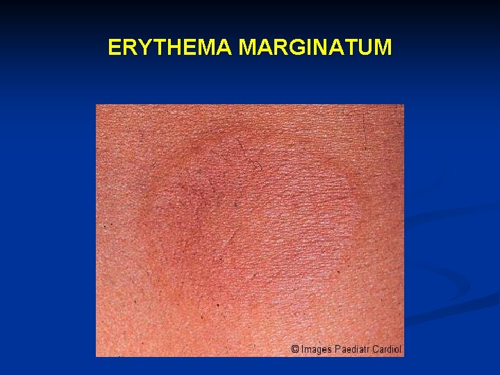 ERYTHEMA MARGINATUM 