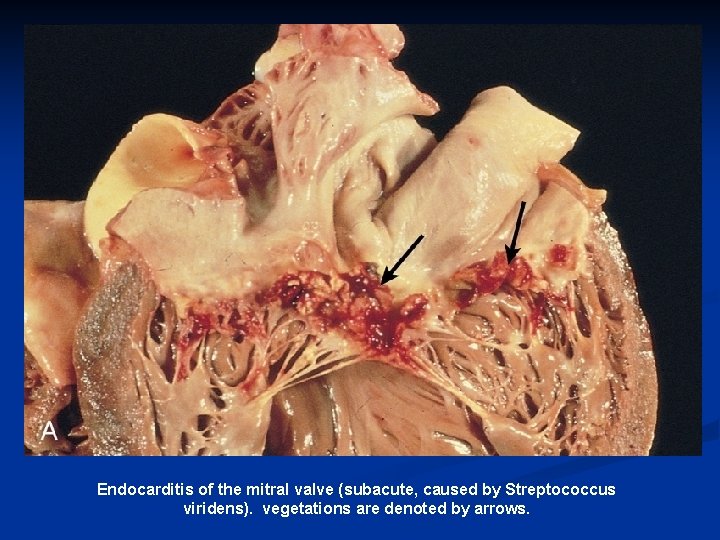 Endocarditis of the mitral valve (subacute, caused by Streptococcus viridens). vegetations are denoted by