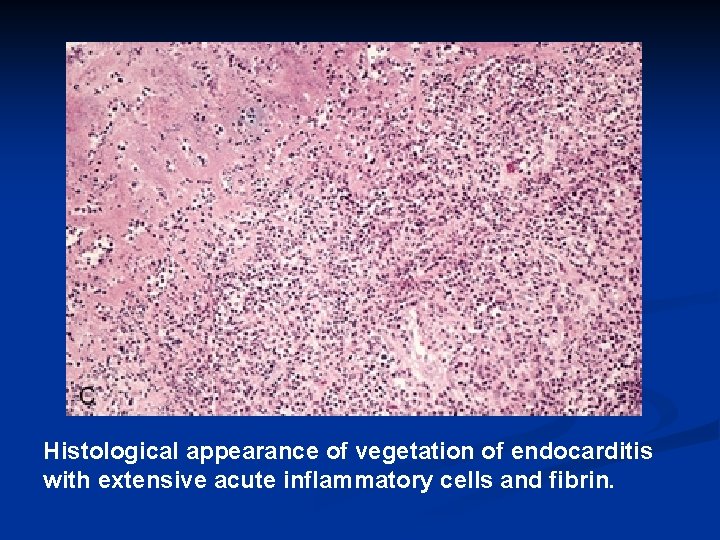 Histological appearance of vegetation of endocarditis with extensive acute inflammatory cells and fibrin. 