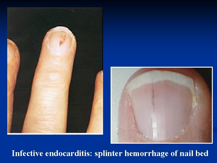 Infective endocarditis: splinter hemorrhage of nail bed 