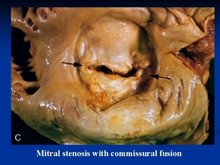 Mitral stenosis with commissural fusion 