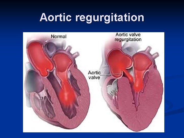 Aortic regurgitation 