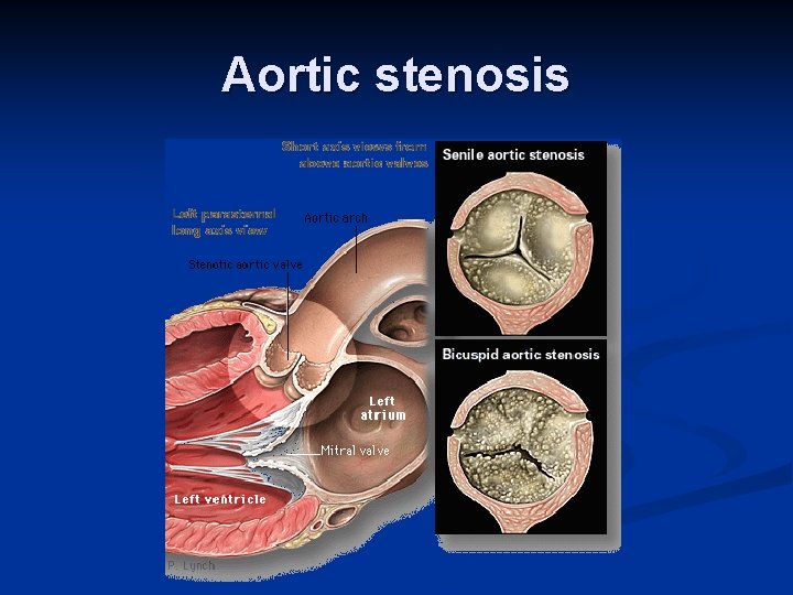Aortic stenosis 