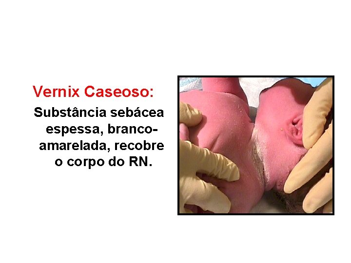 Vernix Caseoso: Substância sebácea espessa, brancoamarelada, recobre o corpo do RN. 