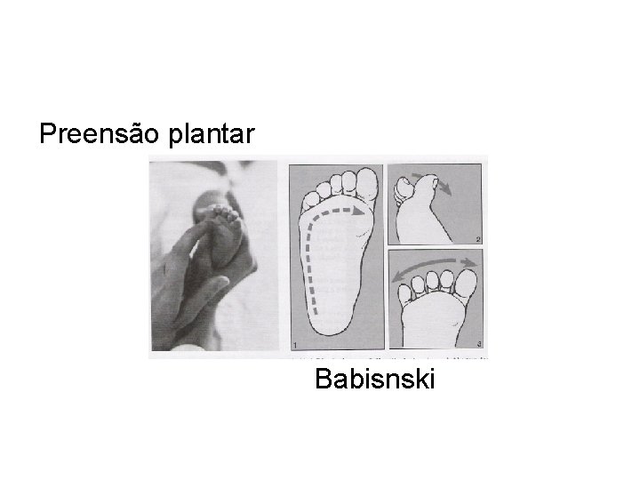 Preensão plantar Babisnski 