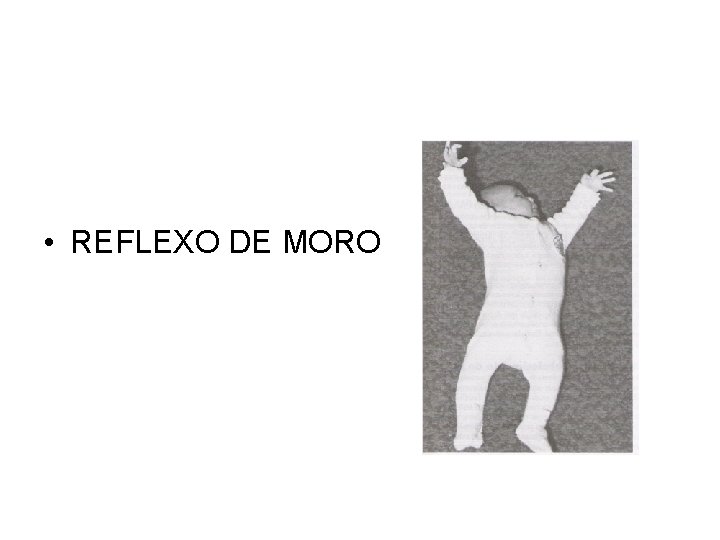  • REFLEXO DE MORO 