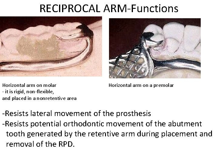 RECIPROCAL ARM-Functions Horizontal arm on molar - it is rigid, non-flexible, and placed in