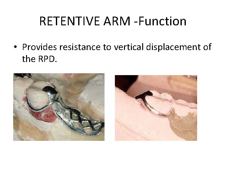 RETENTIVE ARM -Function • Provides resistance to vertical displacement of the RPD. 