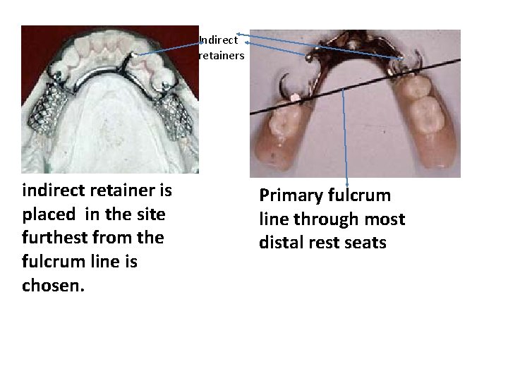 Indirect retainers indirect retainer is placed in the site furthest from the fulcrum line