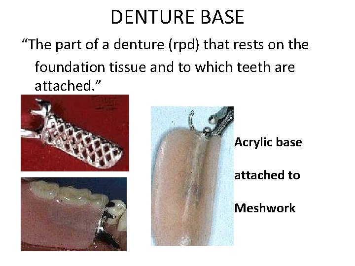 DENTURE BASE “The part of a denture (rpd) that rests on the foundation tissue