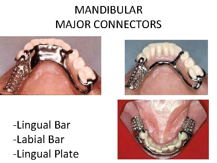 MANDIBULAR MAJOR CONNECTORS -Lingual Bar -Labial Bar -Lingual Plate 