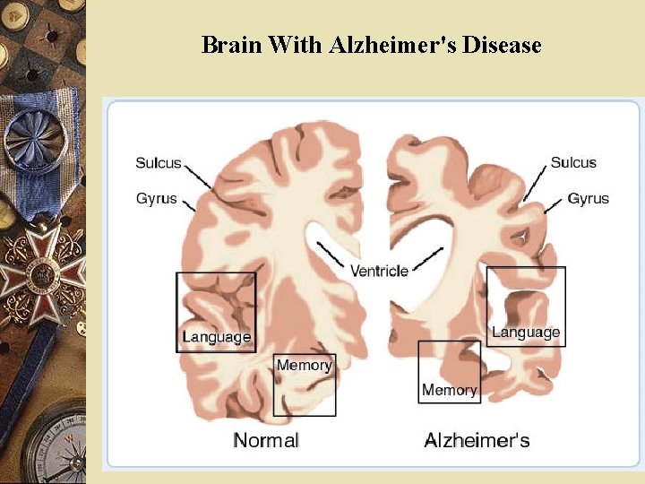 Brain With Alzheimer's Disease 