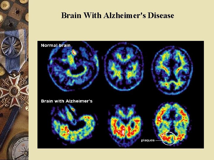 Brain With Alzheimer's Disease 