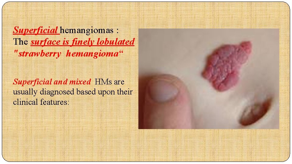 Superficial hemangiomas : The surface is finely lobulated "strawberry hemangioma“ Superficial and mixed HMs