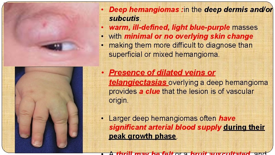 • Deep hemangiomas : in the deep dermis and/or subcutis. • warm, ill-defined,