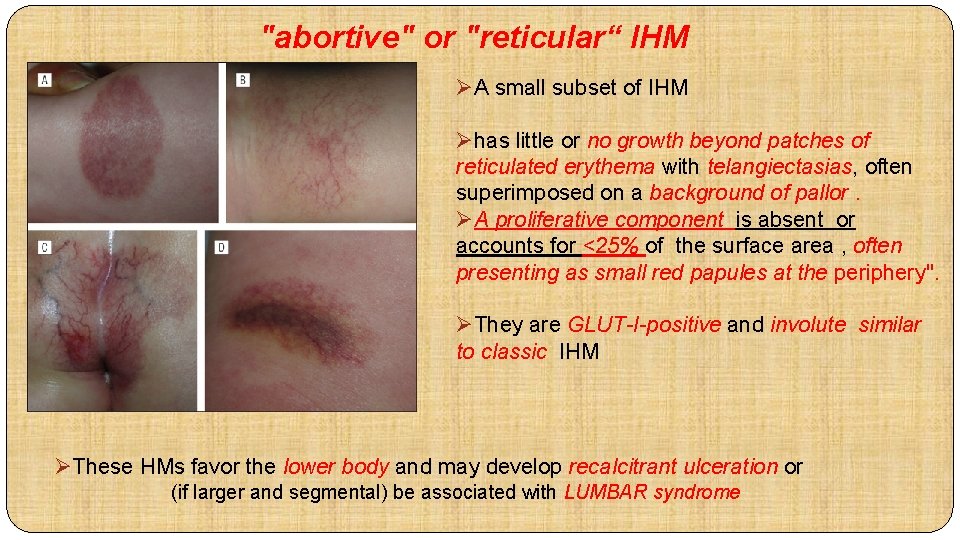 "abortive" or "reticular“ IHM ØA small subset of IHM Øhas little or no growth