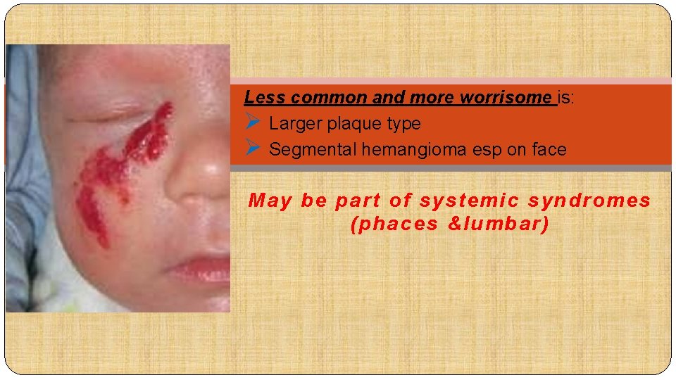 Less common and more worrisome is: Ø Larger plaque type Ø Segmental hemangioma esp