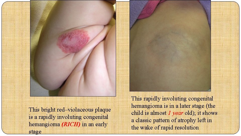 This bright red–violaceous plaque is a rapidly involuting congenital hemangioma (RICH) in an early