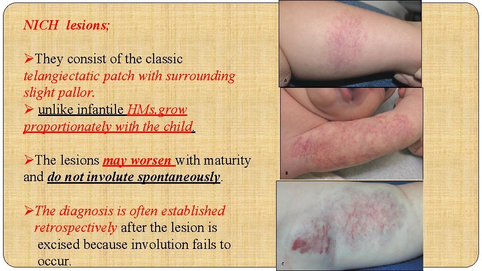 NICH lesions; ØThey consist of the classic telangiectatic patch with surrounding slight pallor. Ø