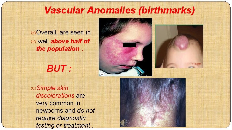 Vascular Anomalies (birthmarks) Overall, are seen in well above half of the population .