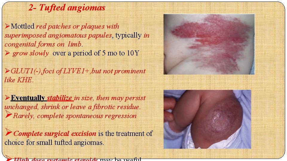  2 - Tufted angiomas ØMottled red patches or plaques with superimposed angiomatous papules,