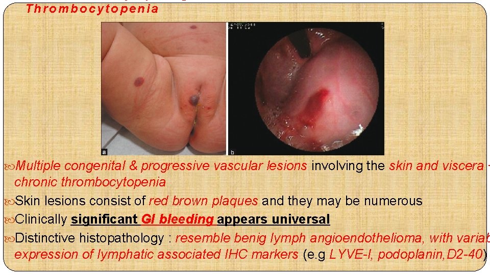 Thrombocytopenia Multiple congenital & progressive vascular lesions involving the skin and viscera + chronic