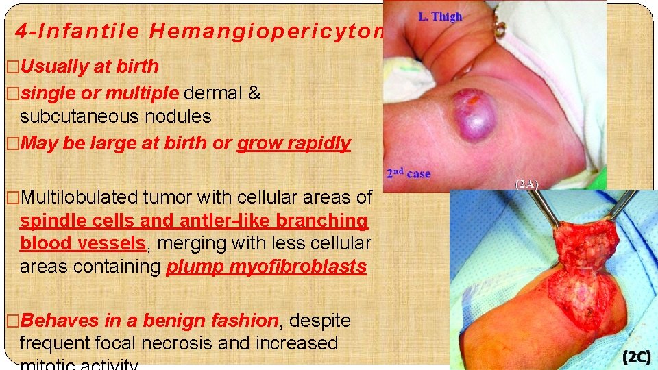 4 -Infantile Hemangiopericytoma �Usually at birth �single or multiple dermal & subcutaneous nodules �May