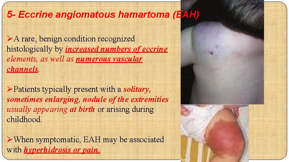 5 - Eccrine angiomatous hamartoma (EAH) ØA rare, benign condition recognized histologically by increased