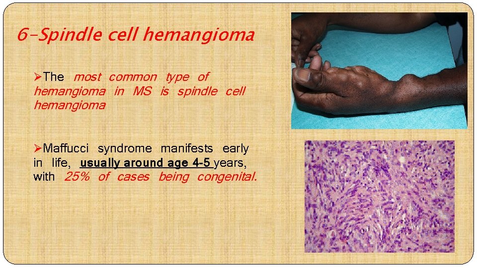 6 -Spindle cell hemangioma ØThe most common type of hemangioma in MS is spindle