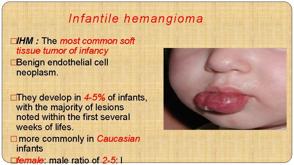Infantile hemangioma �IHM : The most common soft tissue tumor of infancy �Benign endothelial