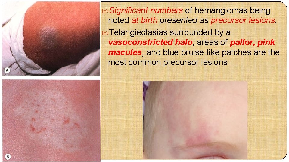  Significant numbers of hemangiomas being noted at birth presented as precursor lesions. Telangiectasias