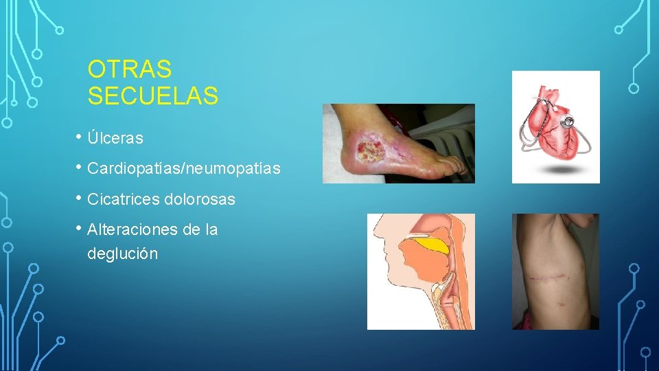OTRAS SECUELAS • Úlceras • Cardiopatías/neumopatías • Cicatrices dolorosas • Alteraciones de la deglución